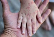 Empat Daerah di Sulsel Berstatus KLB Campak, Dinkes Percepat Penanganan